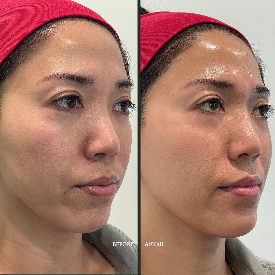 Lip Filler in Pikesville and Baltimore Maryland 00005