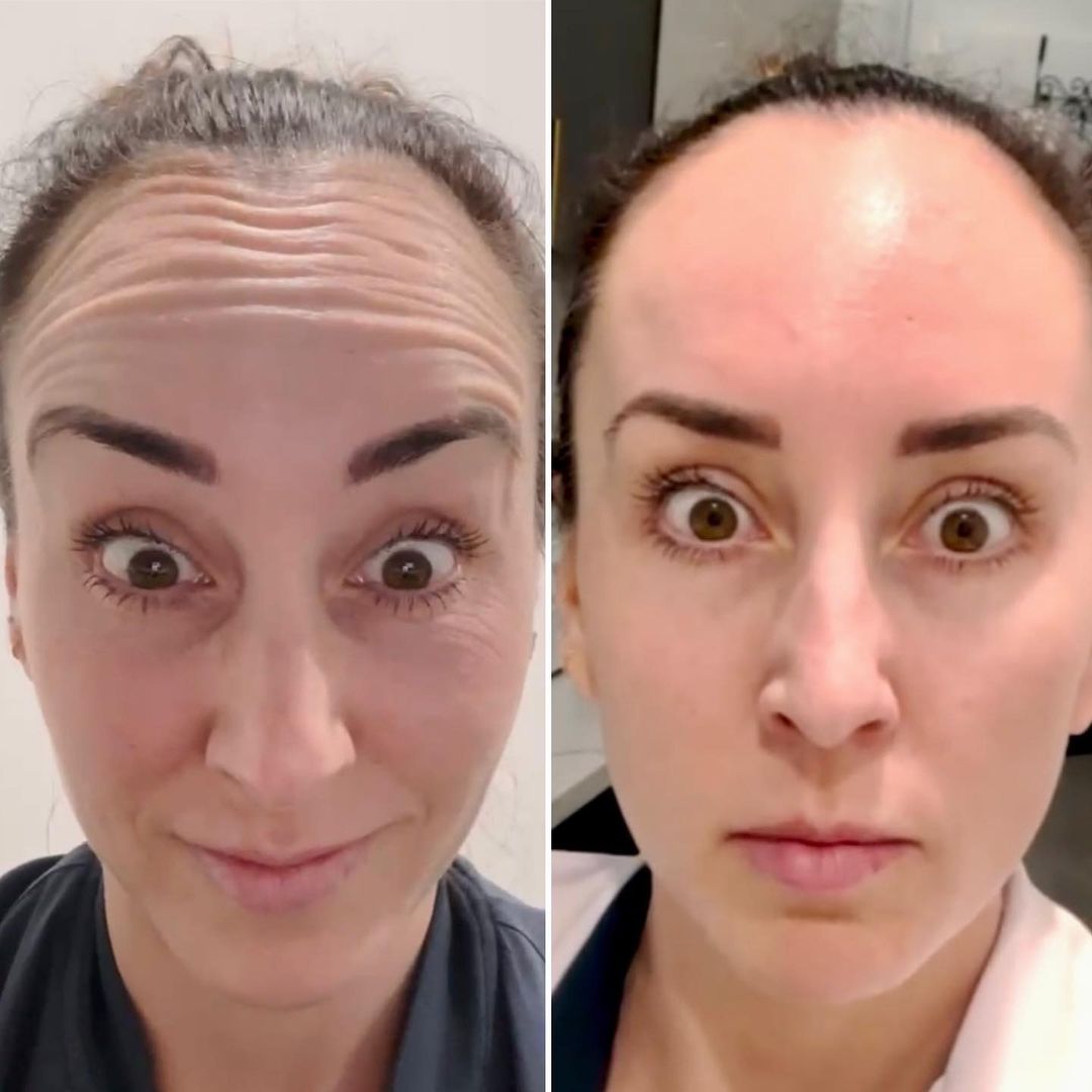 Neurotoxin Botox Before and After in Pikesville & Baltimore Maryland 00002