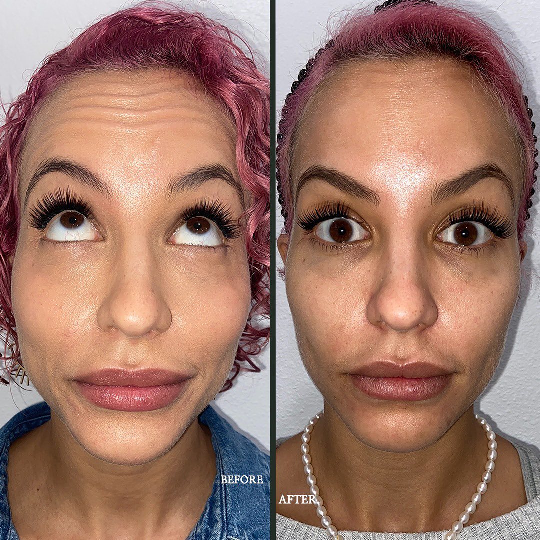Neurotoxin Botox Before and After in Pikesville & Baltimore Maryland 00003