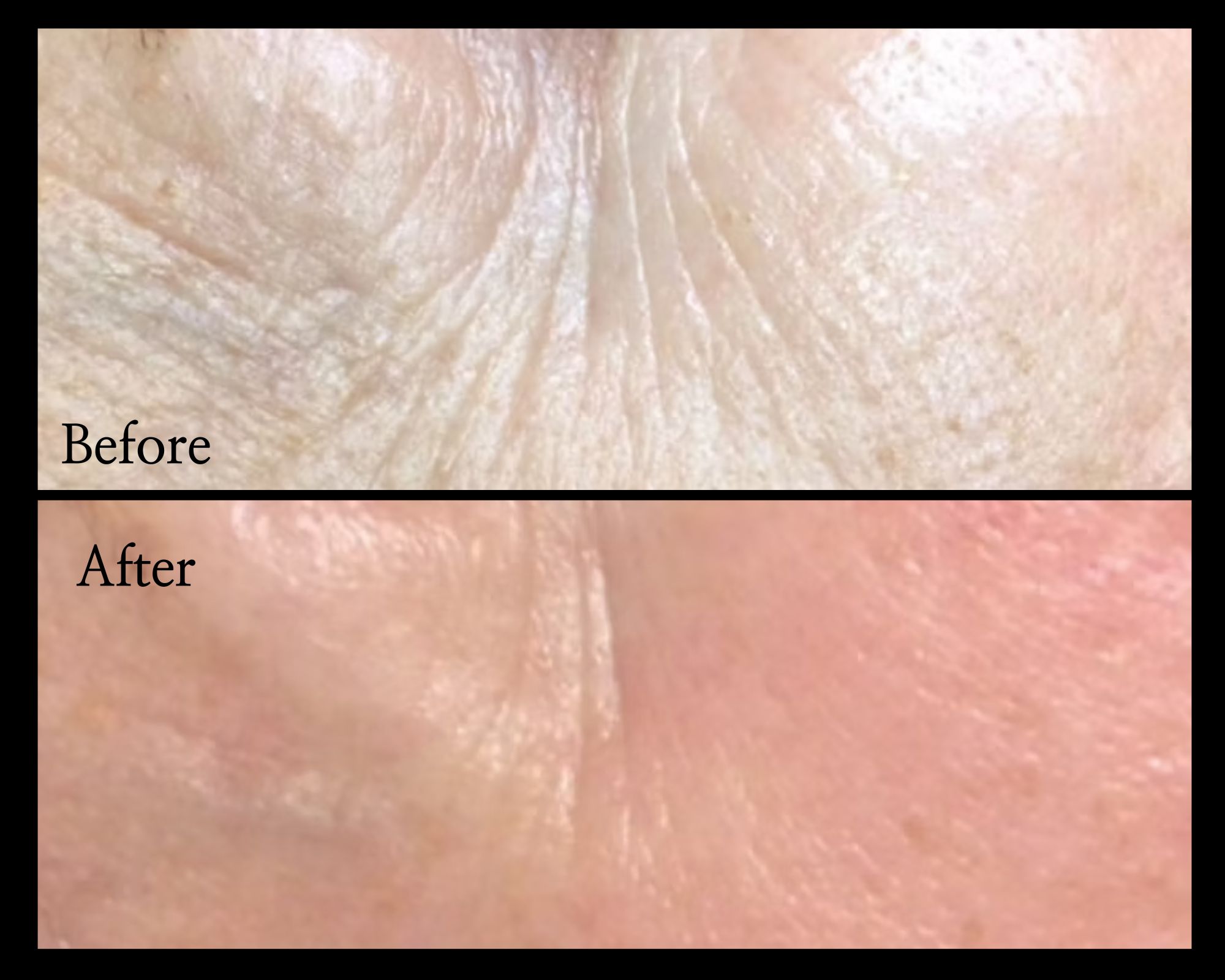 Microneedling-Before-After