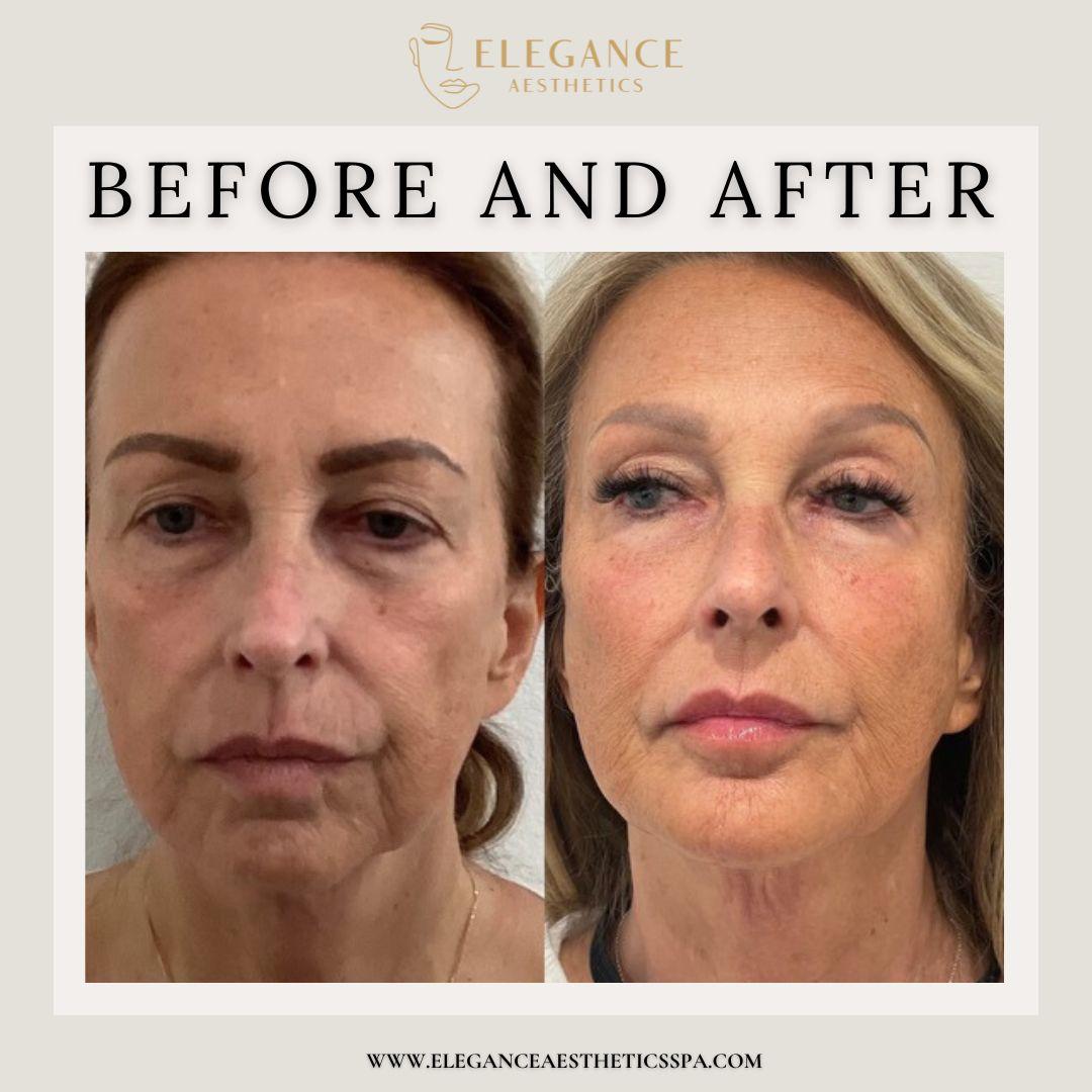 Botox-Before-After-Treatment-in-Baltimore-MD