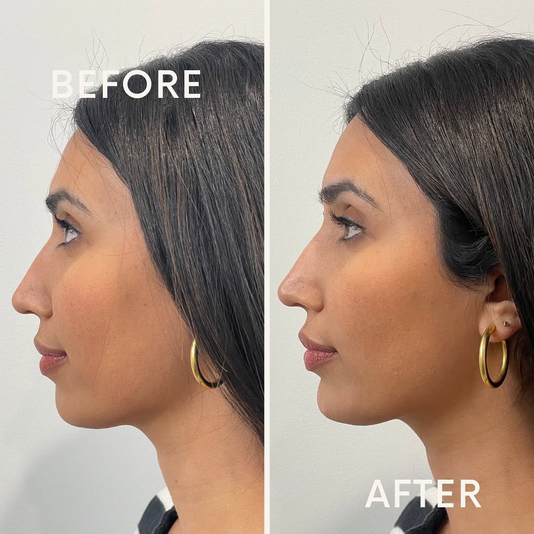 Chin-Filler-in-Baltimore-MD