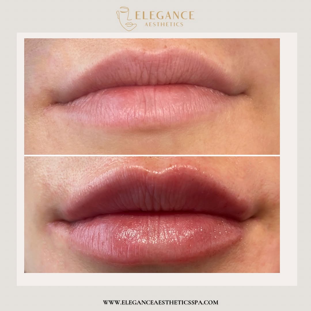 Lip-Filler-in-Baltimore-MD
