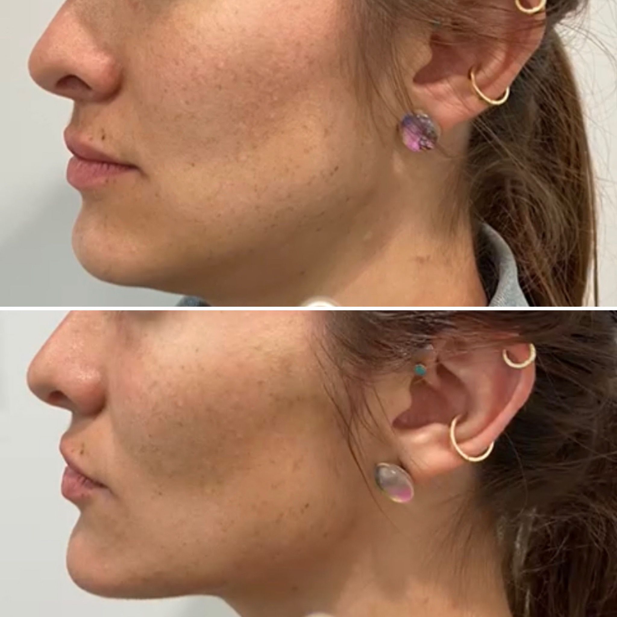 PDO-Before-After-Treatment-in-Baltimore-MD
