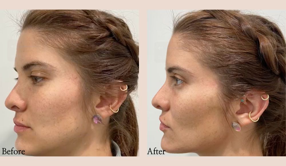 PDO-Threads-Before-After-in-Baltimore-MD