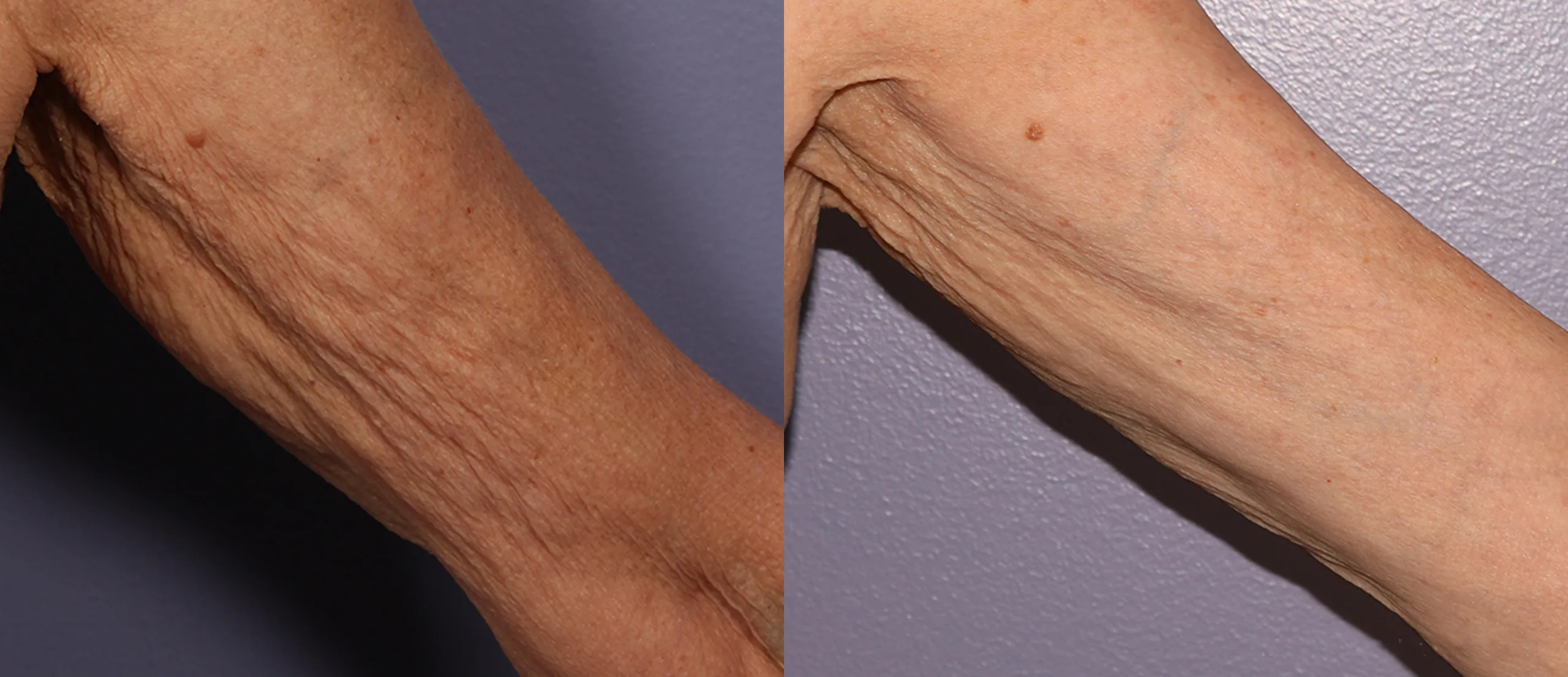 Morpheus8 Before and After Treatment in Baltimore 1