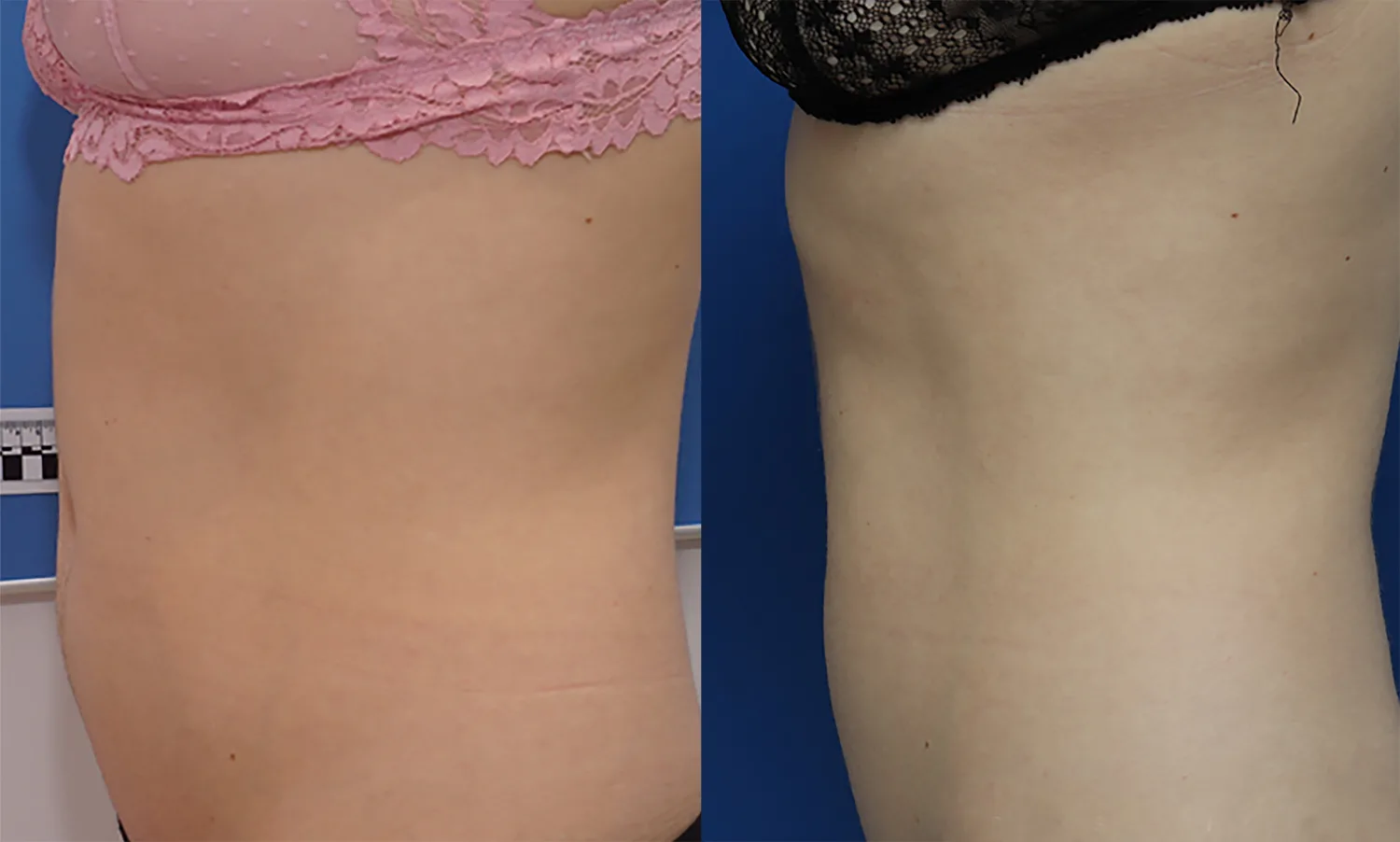 Morpheus8 Before and After Treatment in Baltimore 16
