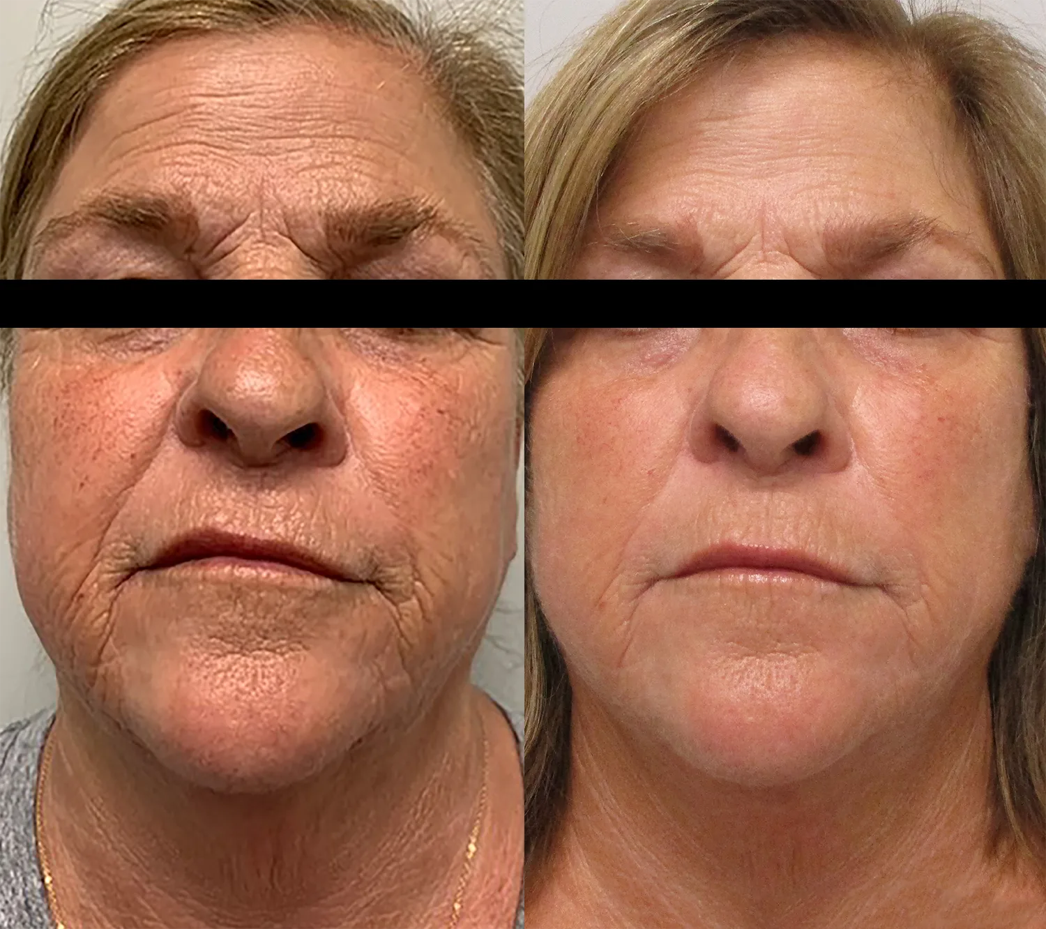 Morpheus8 Before and After Treatment in Baltimore 18